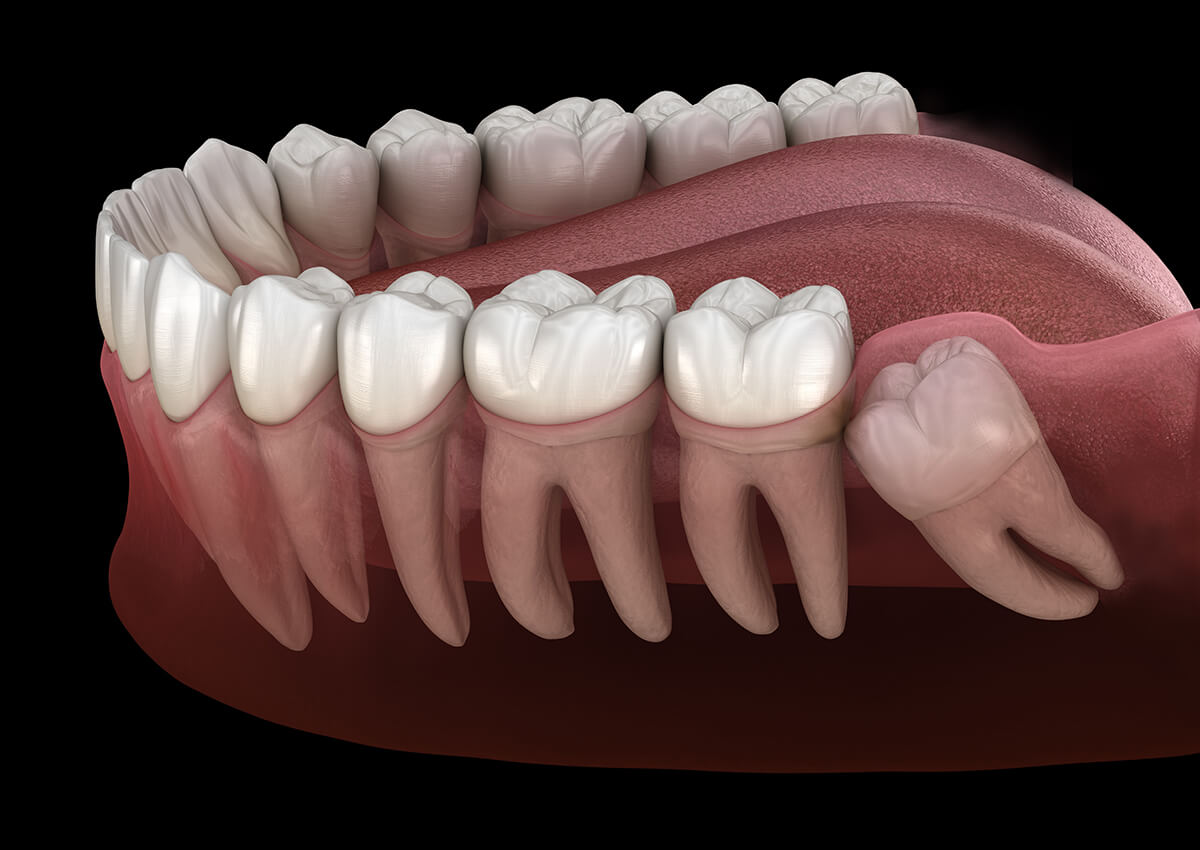 Surgical Extractions