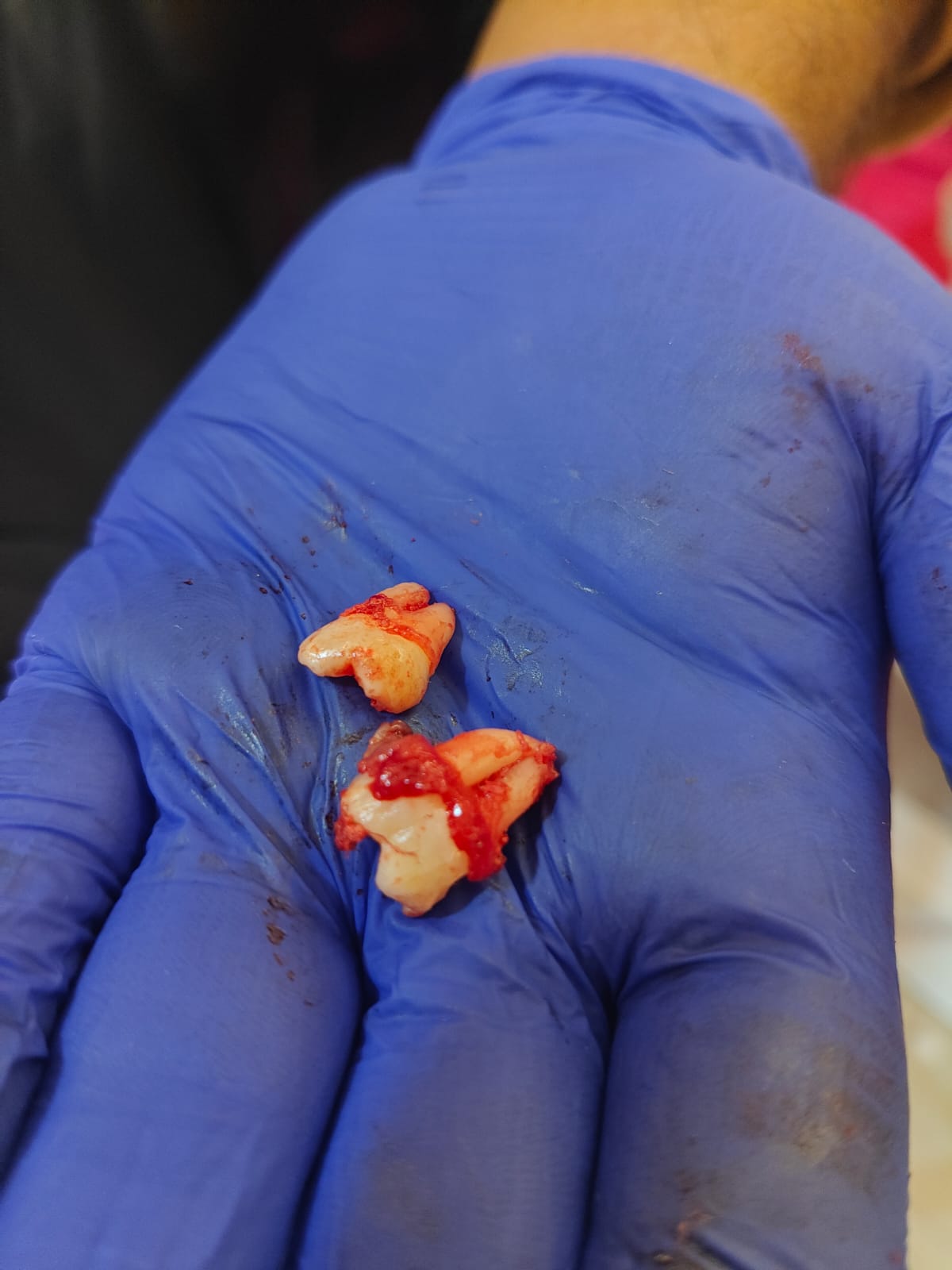Atraumatic Extraction Case I