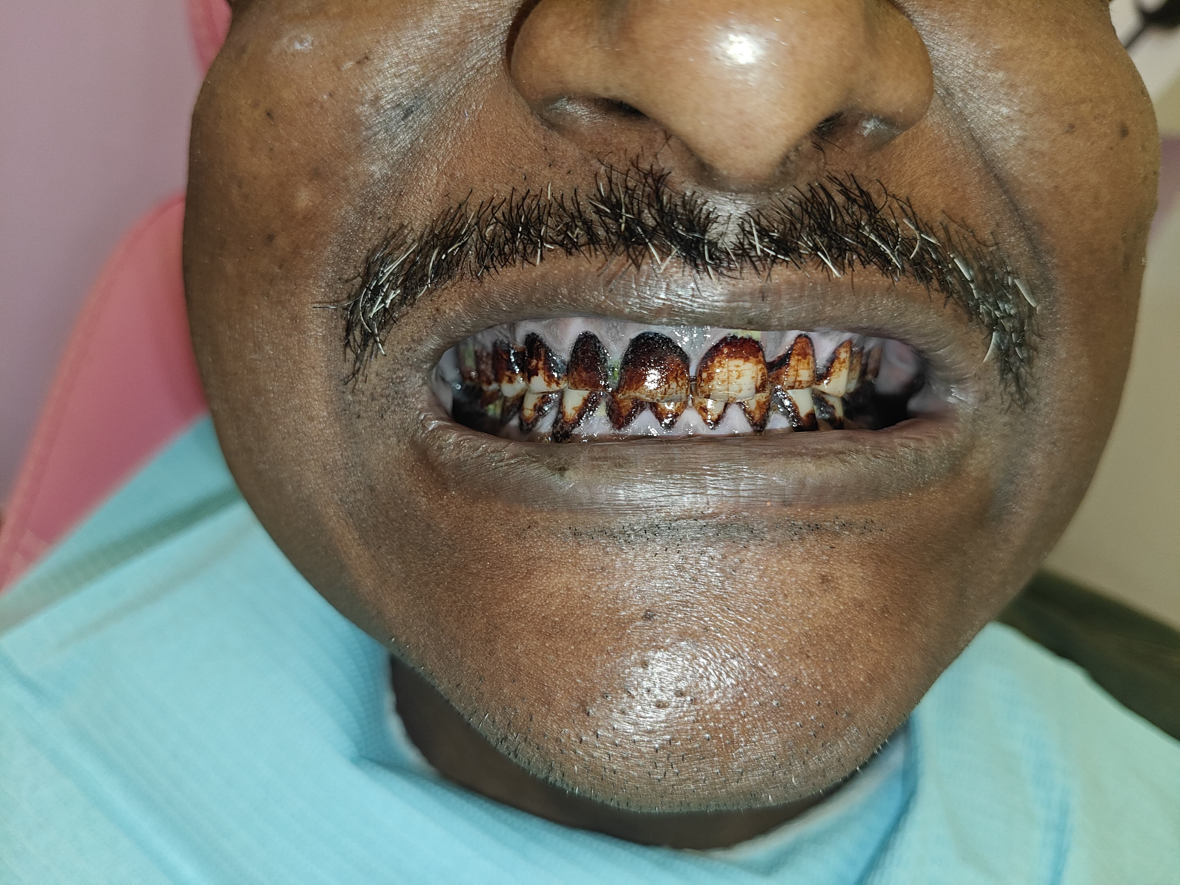 Scaling Treatment In Progress