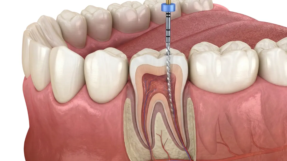 Root Canal Treatment