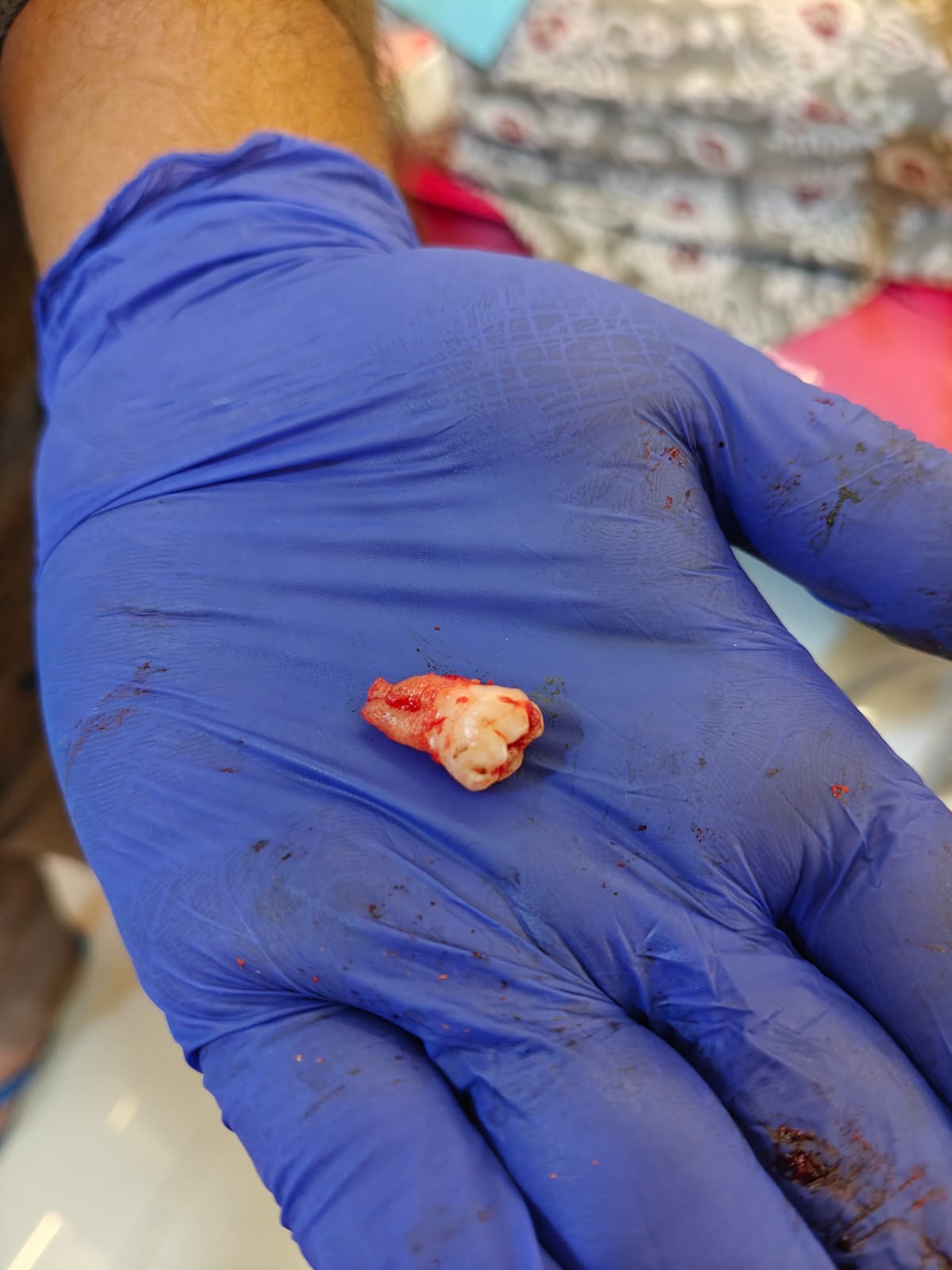 Atraumatic Extraction Case III