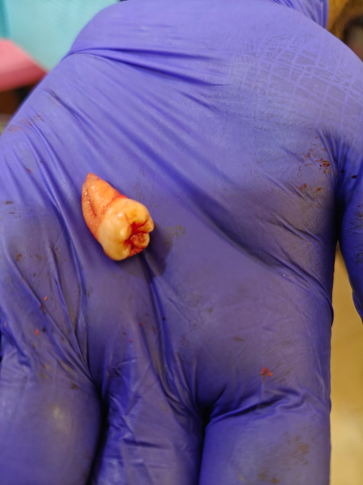 Atraumatic Extraction Case II